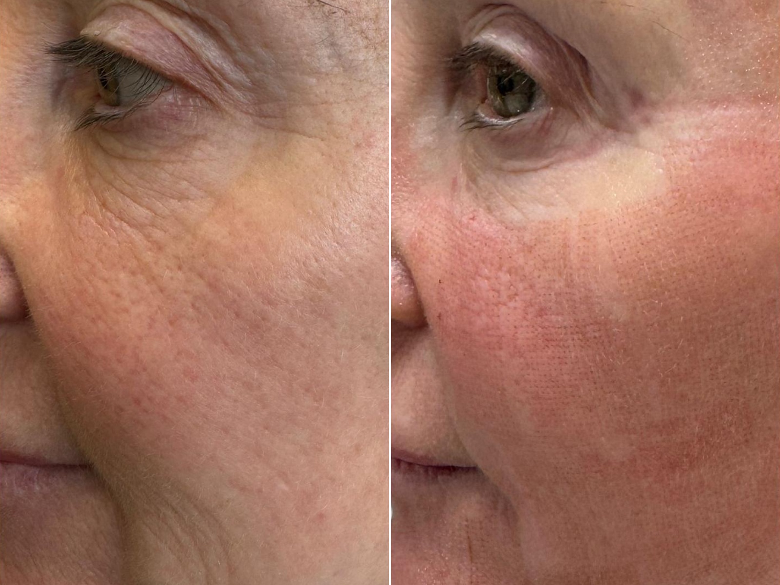 RM Clinics Age Reversal Programme eye and cheek before-and-after result
