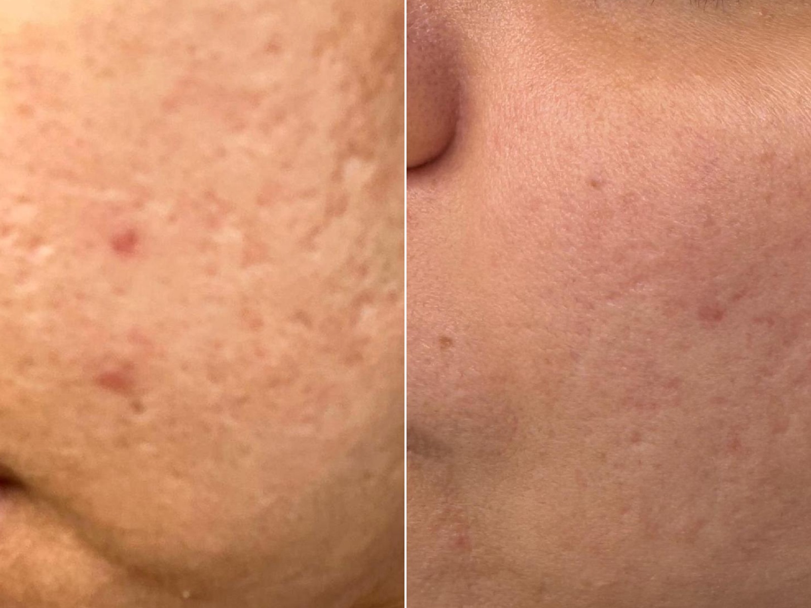 RM Clinics Age Reversal Programme cheek and texture before-and-after result