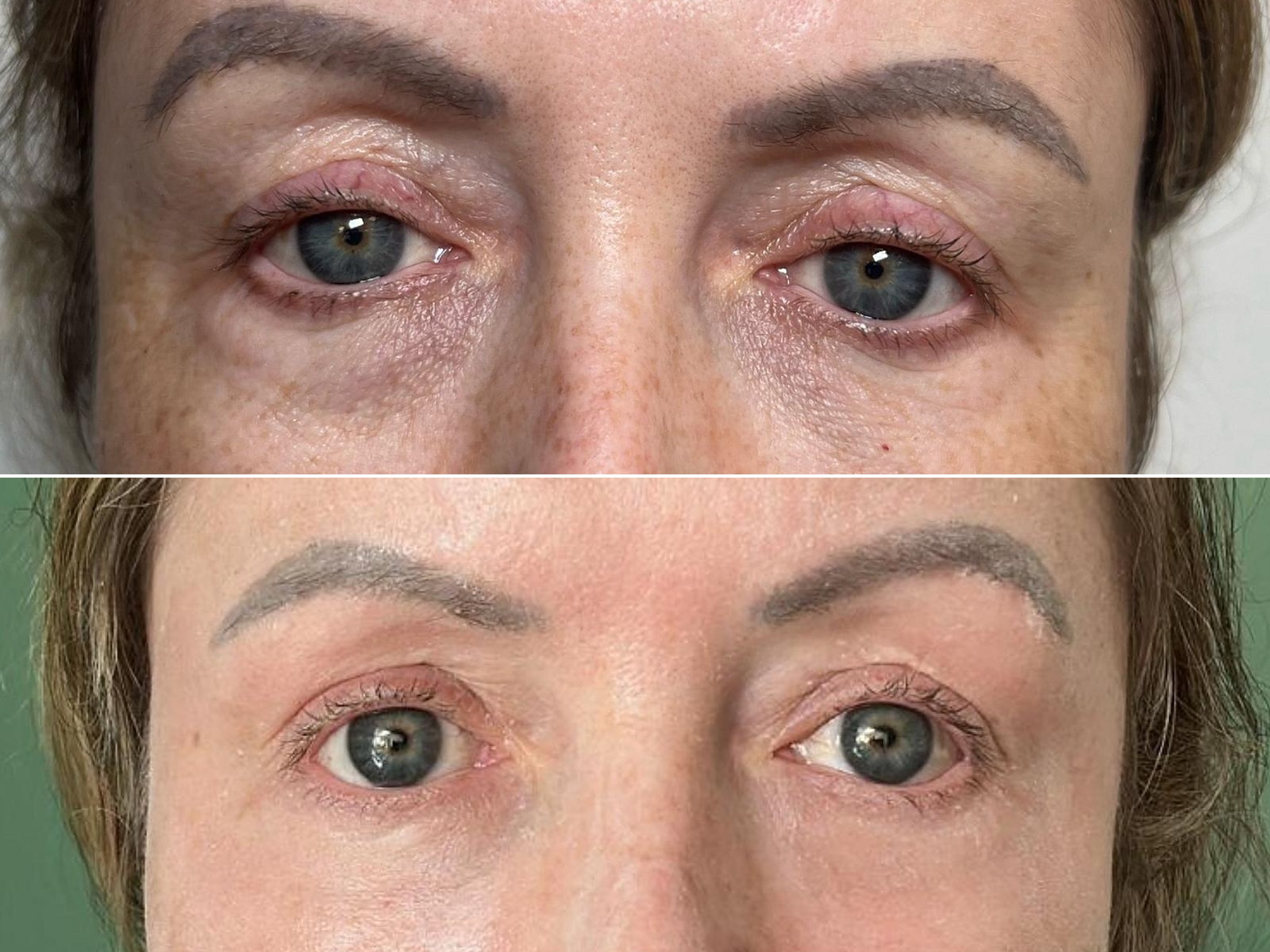 RM Clinics Age Reversal Programme eye-area before-and-after result