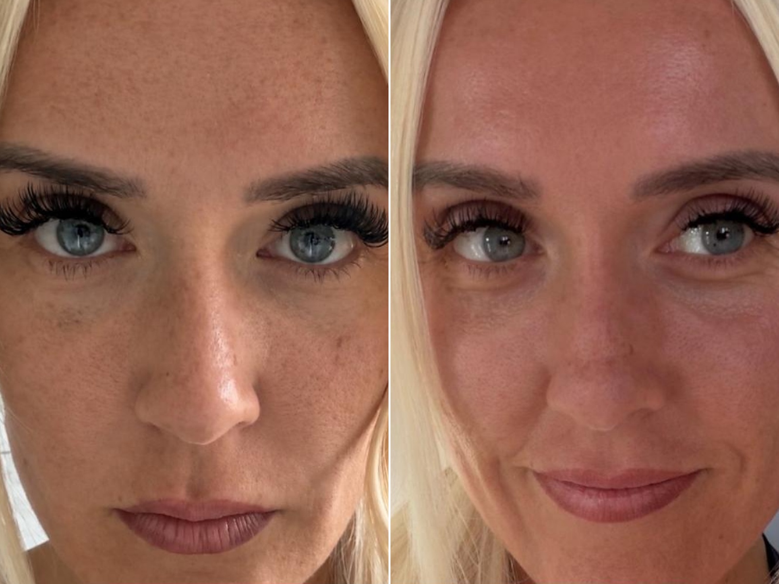 RM Clinics Age Reversal Programme full-face before-and-after result